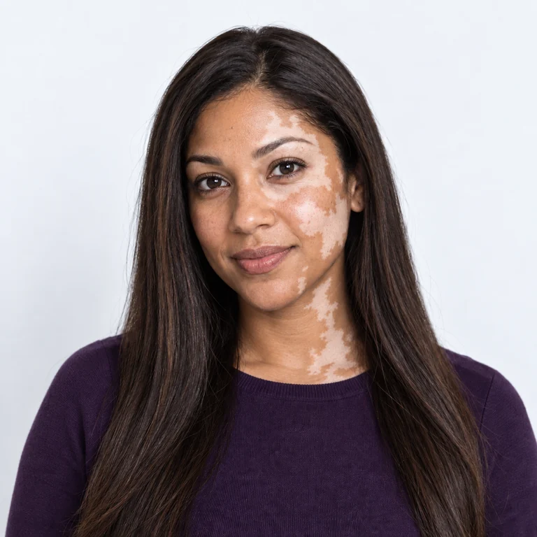 Face 2: Creator with vitiligo, fictional adult reference